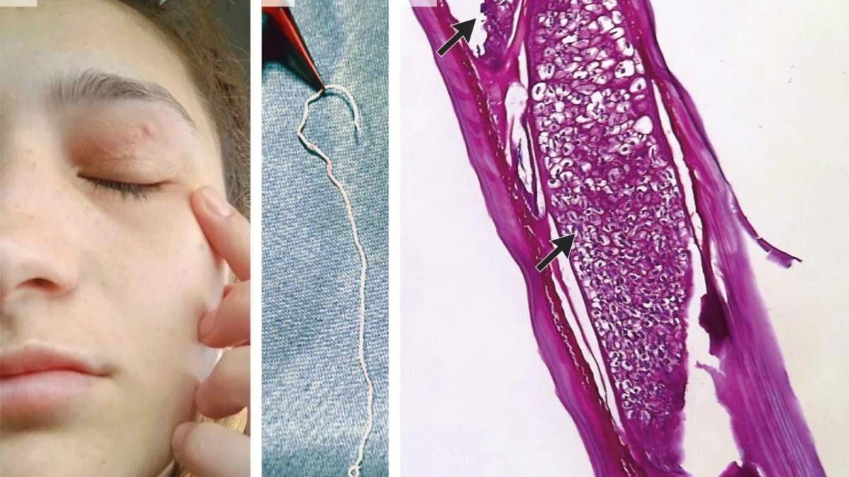 Caz incredibil în medicină! Vierme de unsprezece centimetri în pleoapa unei paciente